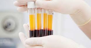 Công nghệ làm đầy sẹo lõm PRF (Platelet-Rich Fibrin) 