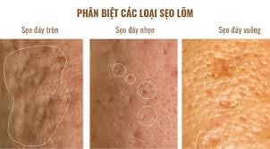 Phân biệt sẹo lõm