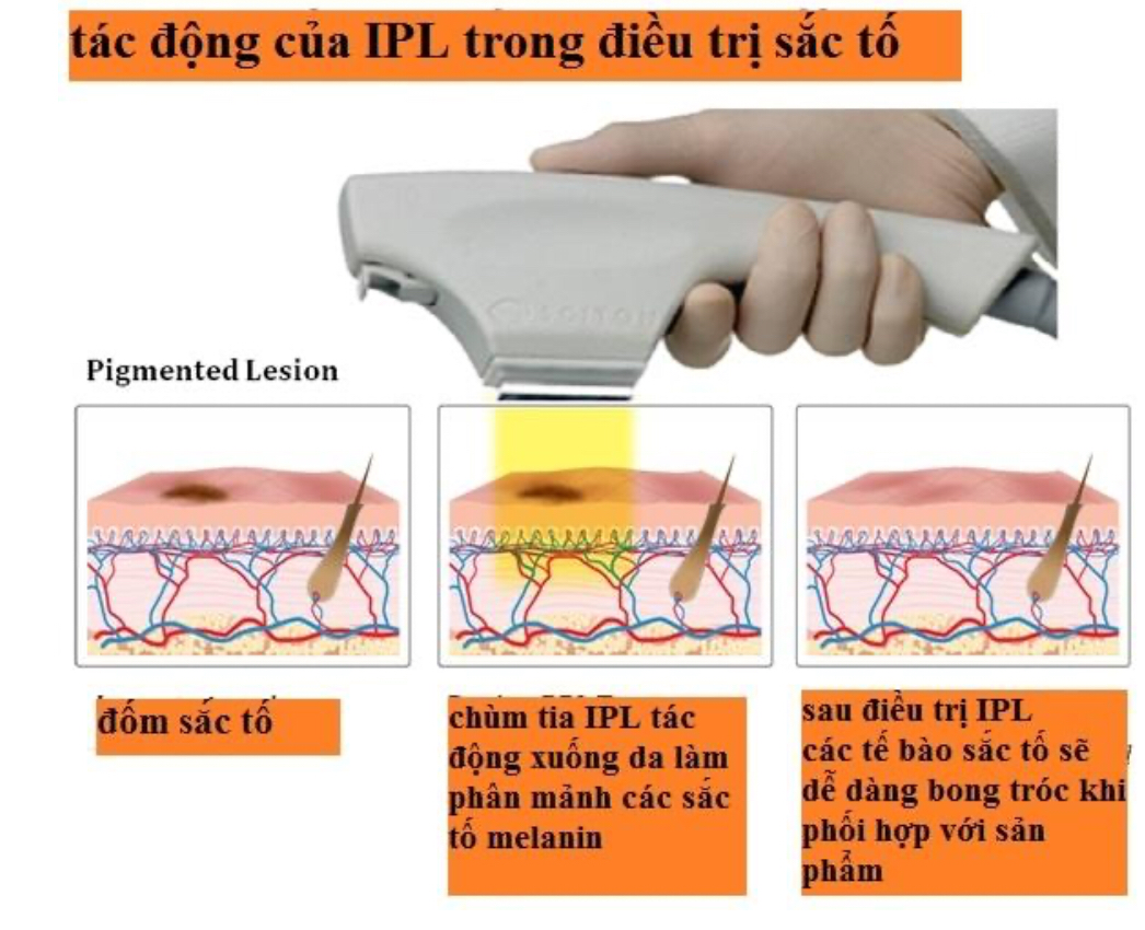 điều trị nám bằng IPL