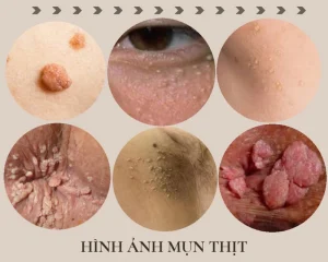 Mụn thịt trên mặt: Nguyên nhân và cách chữa trị tại nhà an toàn