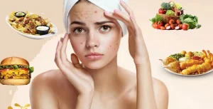 các loại thực phẩm không nên ăn khi bị mụn