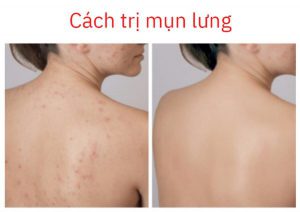 mụn bọc ở lưng