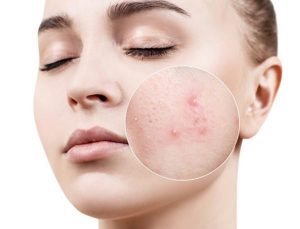 Nên bôi kem trị mụn trước hay sau serum?