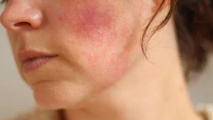 ngăn ngừa dị ứng kem chống nắng