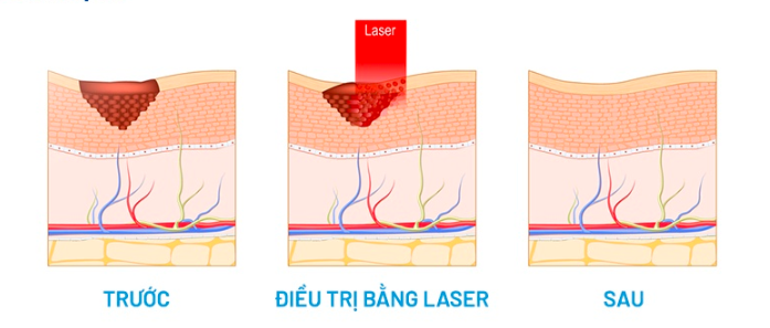 dieu-tri-bot-ca-phe-sua-hieu-qua-va-an-toan