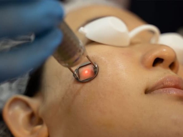 Điều trị tàn nhang bằng laser