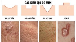 2 Cách phân biết sẹo lồi sẹo lõm