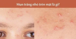 Mụn Đầu Trắng quanh mặt Cách Điều Trị ?