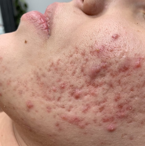 3 cách trị sẹo thâm bằng công nghệ mới nhất hiện nay