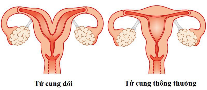 4 Hình thái dị dạng của tử cung