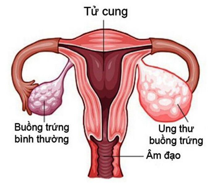 ung thư buồng trứng