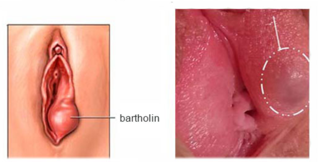 Áp xe tuyến Bartholin Là gì?Nguyên nhân, triệu chứng và cách điều trị