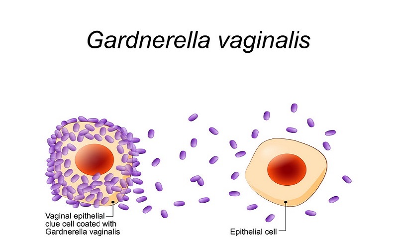 Viêm âm đạo do Gardnerella.