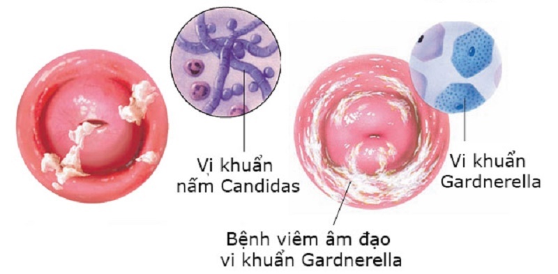 Viêm âm đạo do vi khuẩn 