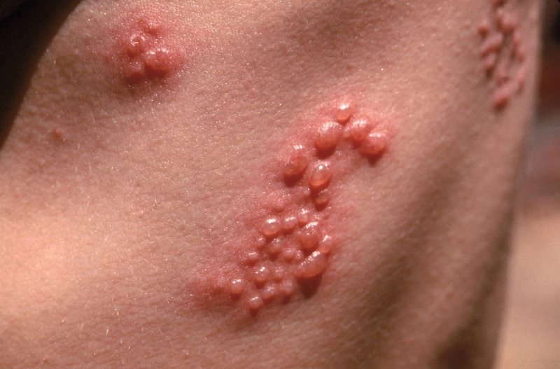 Virus herpes là gì và dấu hiệu nhận biết bệnh do virus này gây ra