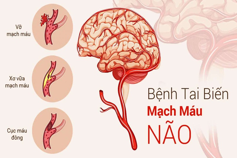 Tai biến mạch máu não cũng làm tăng nguy cơ tử vong cao 