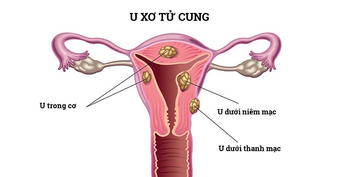 U xơ tử cung là gì?