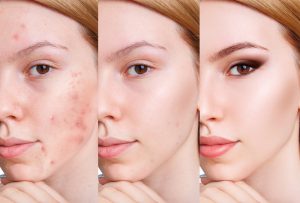 Lưu ý khi thực hiện các bước skincare cho da mụn