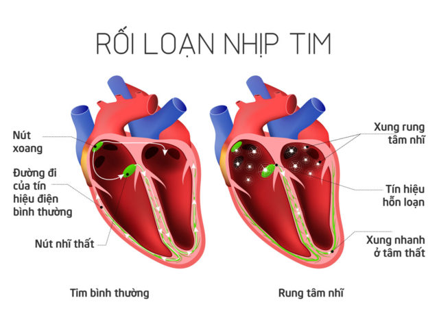 Rối loạn nhịp tim là tình trạng cần được can thiệp kịp thời để ngăn ngừa biến chứng làm tổn thương tim