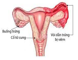 Bệnh Chlamydia có thể gây ra những vấn đề gì?