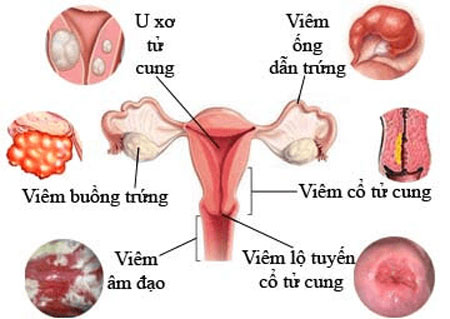 bệnh phụ khoa là gì