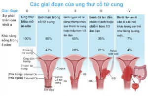 các giau đoạn của ung thư cổ tử cung