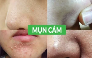 7 bước trị mụn cám tại nhà tự nhiên và cực kì hiệu quả