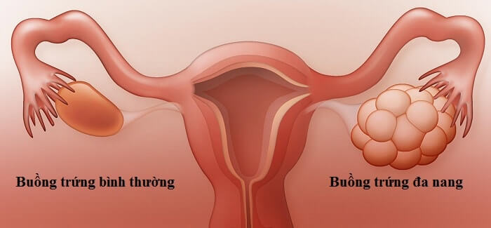 Những Rối Loạn Từ Buồng Trứng Và Hậu Quả Lên Da