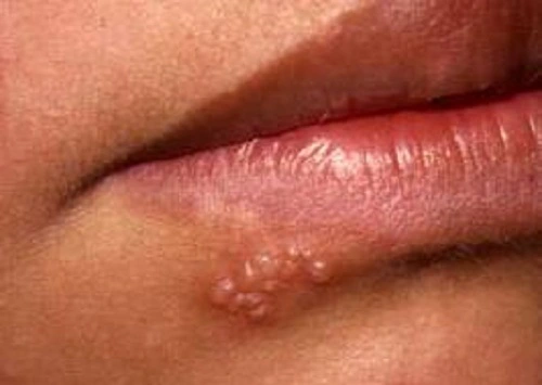 Virus herpes là gì và dấu hiệu nhận biết bệnh do virus này gây ra