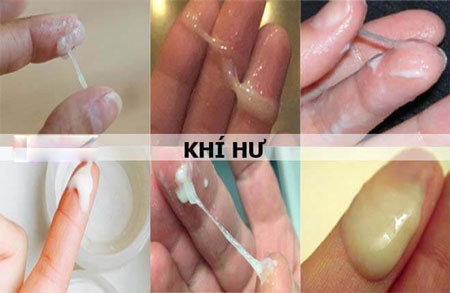 Ra khí hư màu trắng đục không mùi không ngứa có bình thường không?