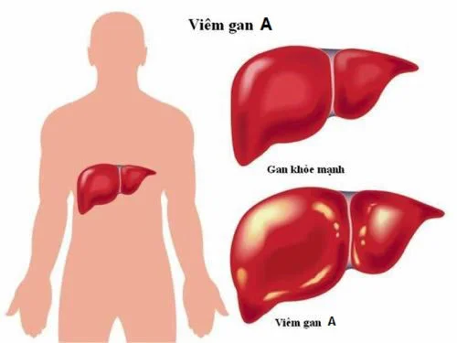 Những bệnh đường tình dục được ngăn ngừa nhờ tiêm vaccine?