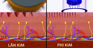 Phân biệt lăn kim và phi kim khác nhau như thế nào?