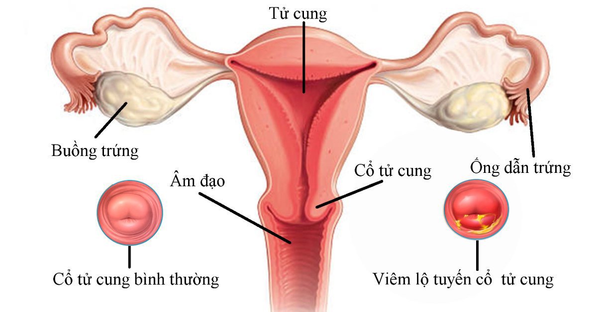 Tử cung là gì?