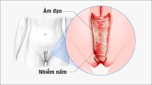 Nhiễm trùng nấm âm đạo trước kỳ kinh nguyệt điều trị Như thế nào tại nhà?