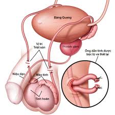 Triệt sản ở nam và nữ mà bạn nên biết