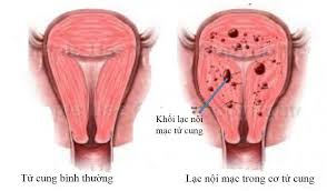 Có kinh nguyệt 2 lần một tháng có nguy hiểm không?