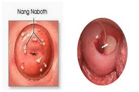 Nang naboth cổ tử cung là gì?