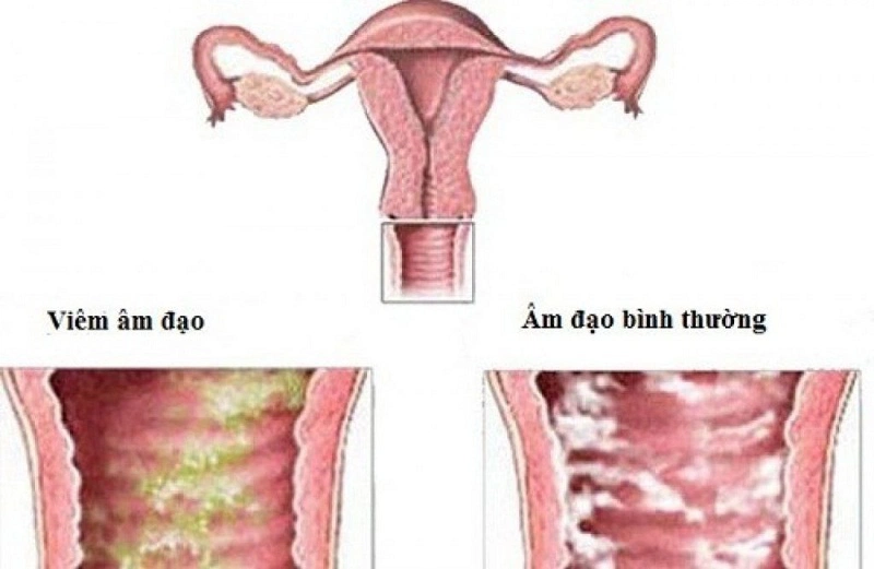 Viêm âm đạo do nấm Candida vùng kín