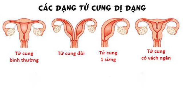 4 Hình thái dị dạng của tử cung