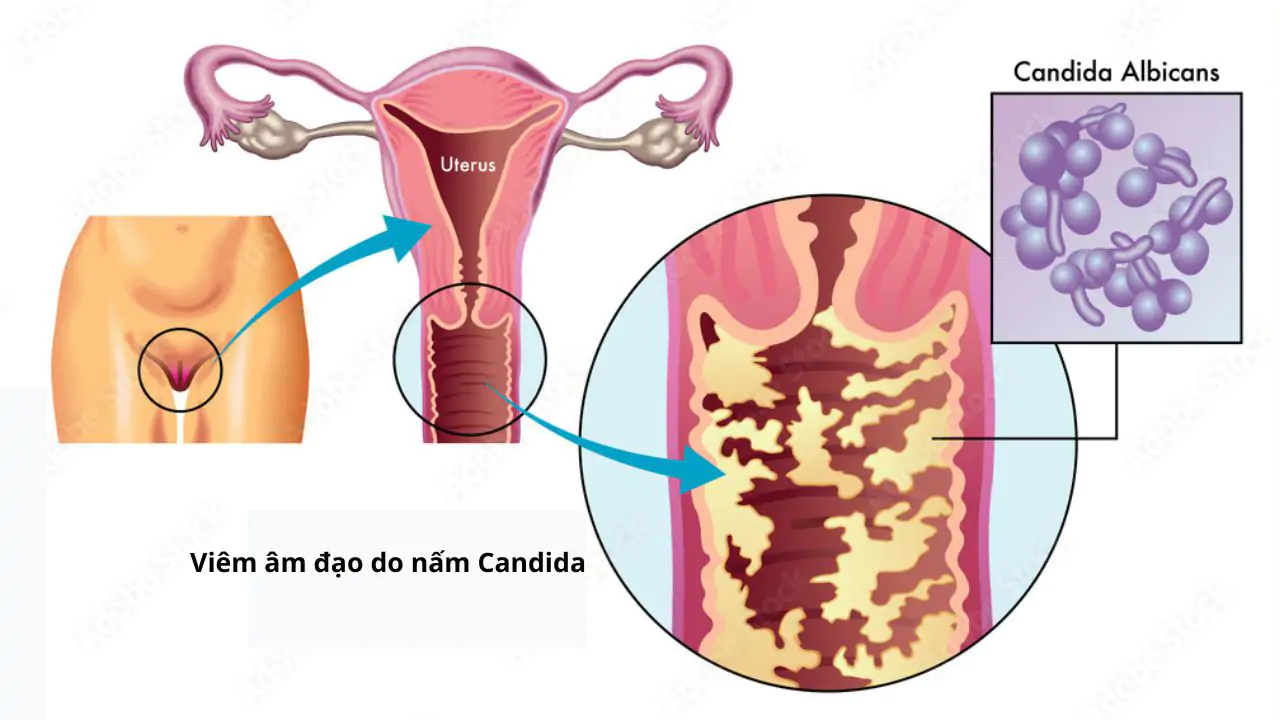 Cách chấm dứt căn bệnh dai dẳng ở vùng kín