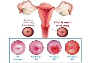 Viêm lộ tuyến tử cung là gì?