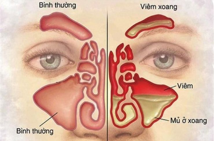 Phân biệt viêm xoang