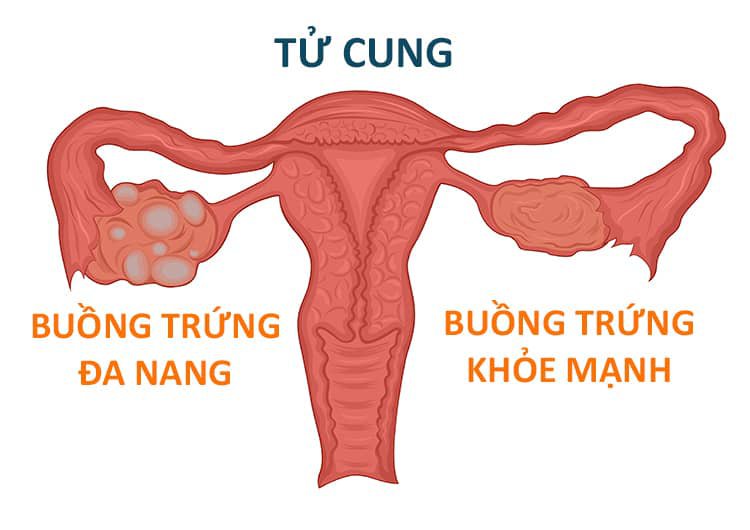 Chế độ ăn ít đường và tác động tích cực đến buồng trứng đa nang