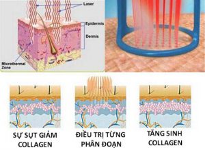 Laser CO2 Fractional là gì? Cách chăm sóc da sau khi thực hiện Laser CO2 Fractional