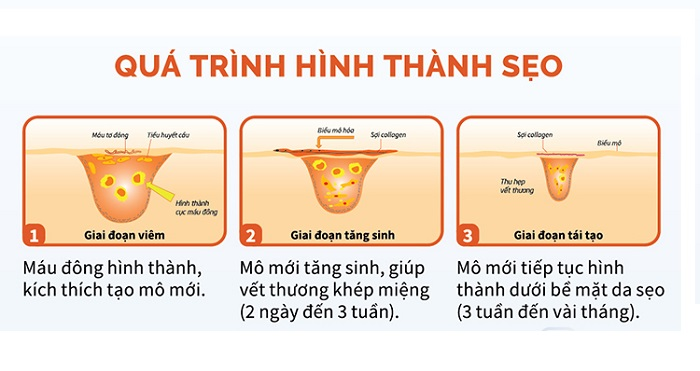 Vết Sẹo Là Gì? Tất Tần Tật Từ A Đến Z Về Nguyên Nhân, Cách Điều Trị Và Phòng Ngừa