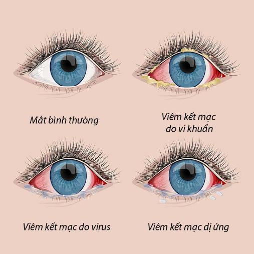 Viêm giác mạc là bệnh gì? Nguyên nhân, triệu chứng, cách phòng tránh