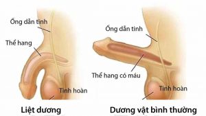 Rối Loạn Cương Dương Nguyên Nhân, Triệu Chứng và Giải Pháp Hiệu Quả