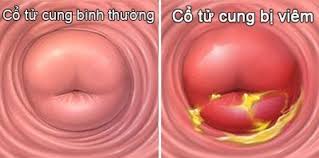 Dinh Dưỡng Hỗ Trợ Trị Viêm Tử Cung Mãn Tính: Giải Pháp Từ Thiên Nhiên Để Tăng Cường Sức Khỏe Phụ Khoa