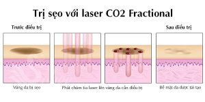 Laser CO2 Fractional là gì? Có thật sự tốt? Ưu và khuyết điểm